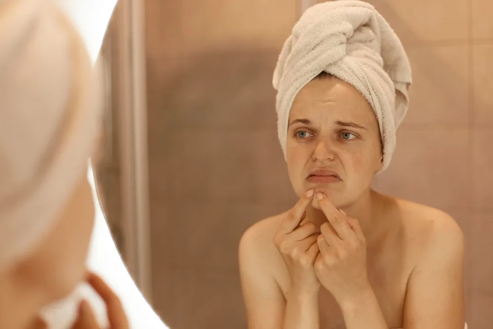 Môže mlieko alebo čokoláda zhoršiť vaše akné?