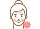 Rosacea